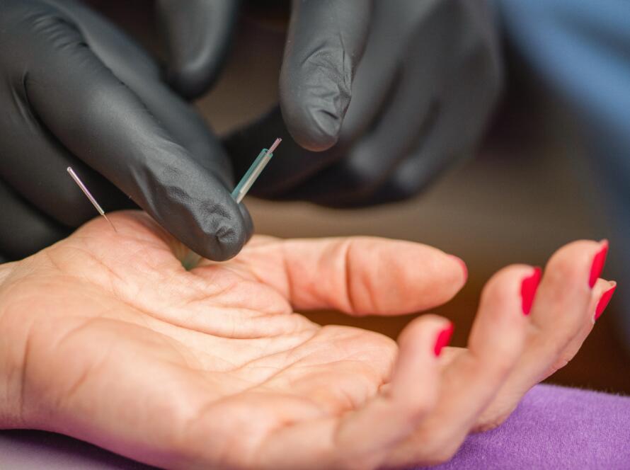 Dry needling treatment on a patient’s hand performed by a Gardner Physical Therapy specialist.